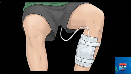 Leg bag illustration
